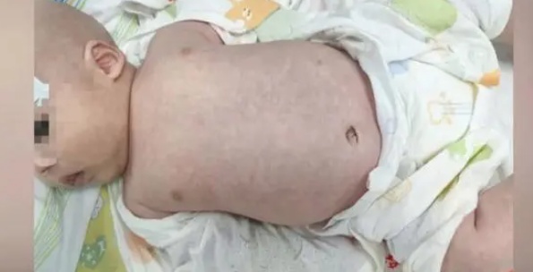 2个月婴儿身体布满"花纹"…发烧后,爸爸这个操作太害人! 2个月婴儿身体布满"花纹"…发烧后,爸爸这个操作太害人!