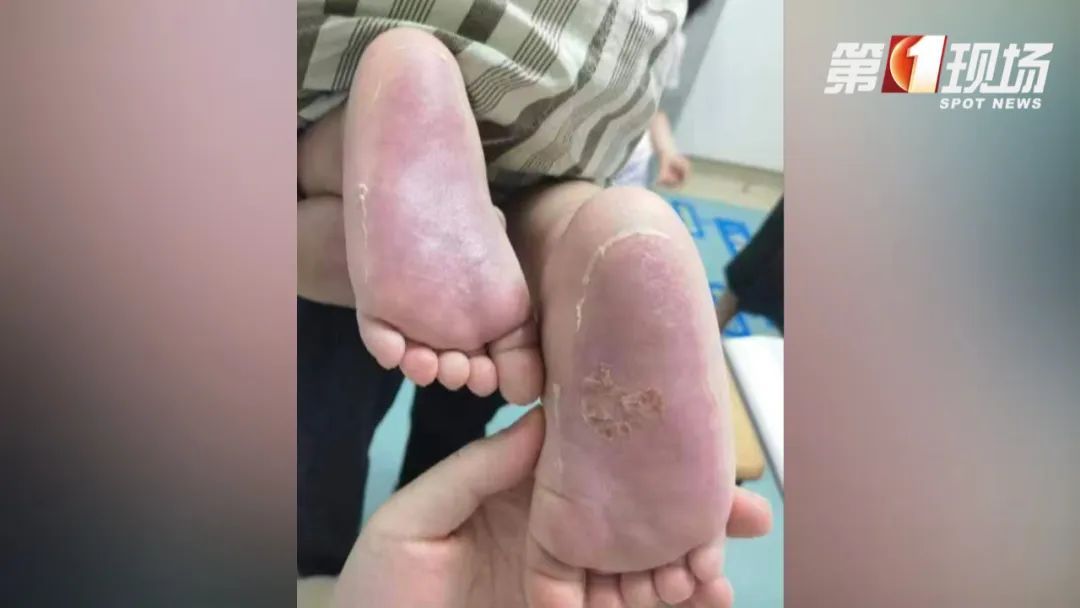 1岁娃户外光脚跑了5分钟，双脚竟被烫伤！炎热天气要小心