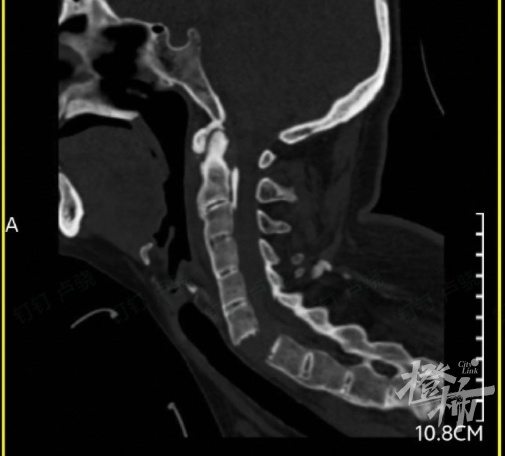 颈椎6至7节完全断离,女子全身瘫痪,只因这项“水上项目” 颈椎6至7节完全断离,女子全身瘫痪,只因这项“水上项目”