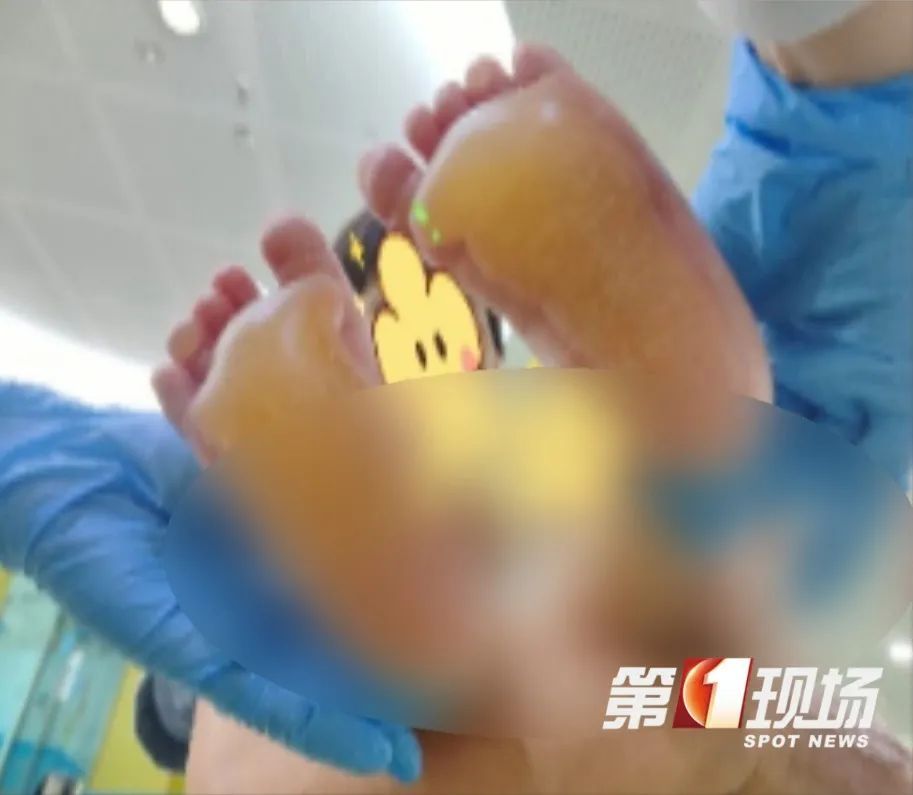 1岁娃户外光脚跑了5分钟，双脚竟被烫伤！炎热天气要小心