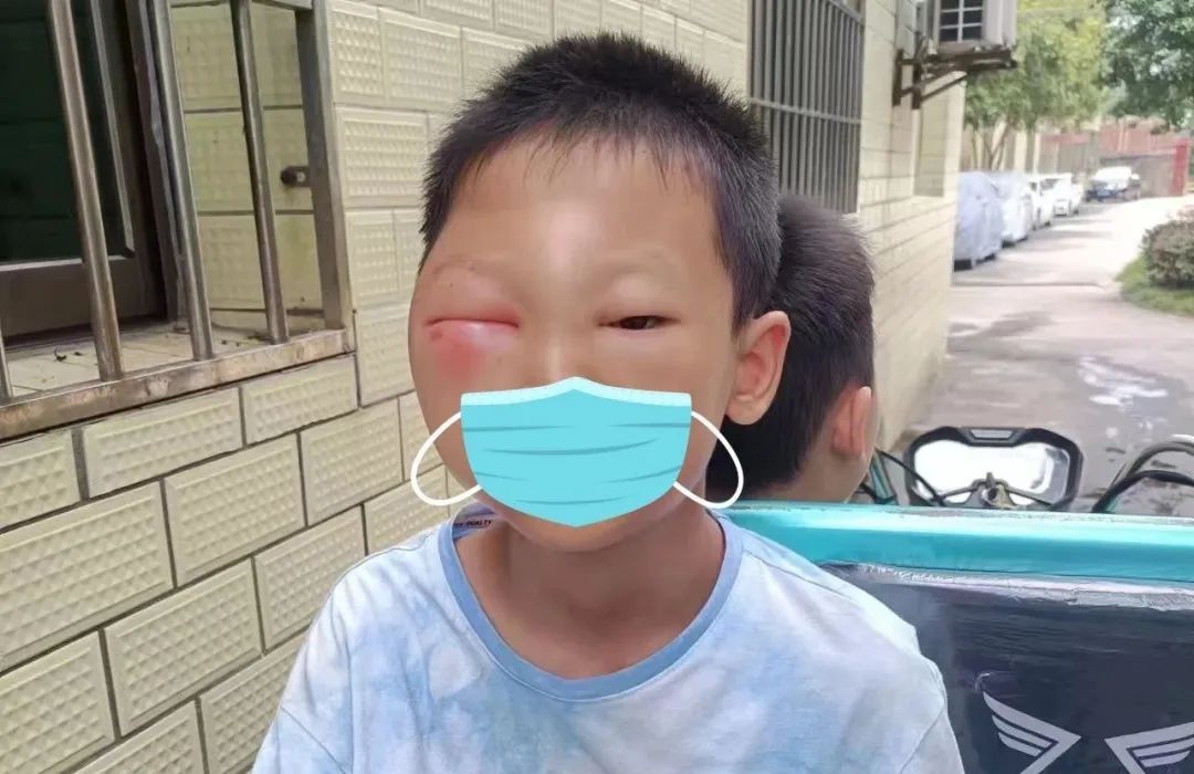 一觉醒来,11岁男童变成了“猪猪侠”!进入多发季,医生提醒…… 一觉醒来,11岁男童变成了“猪猪侠”!进入多发季,医生提醒……