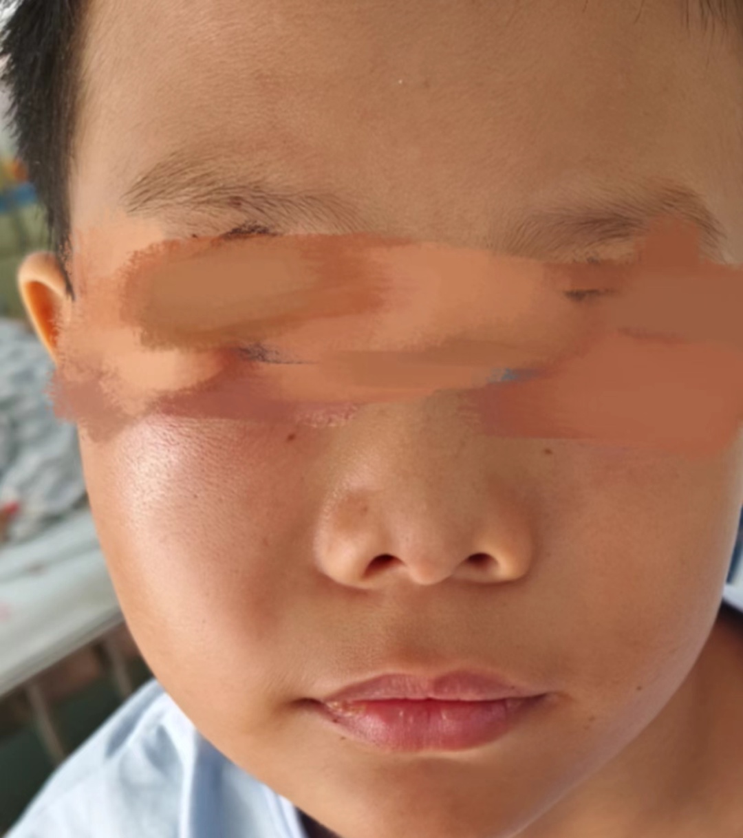 一觉醒来,11岁男童变成了“猪猪侠”!进入多发季,医生提醒…… 一觉醒来,11岁男童变成了“猪猪侠”!进入多发季,医生提醒……