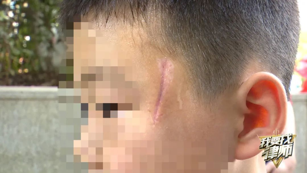 七岁男童在游泳馆被划伤面部缝了9针……发生了什么? 七岁男童在游泳馆被划伤面部缝了9针……发生了什么?