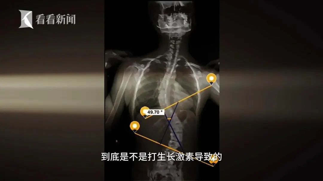 一针长高10厘米? 副作用惊人？上海这个门诊全是人，有家长悔哭