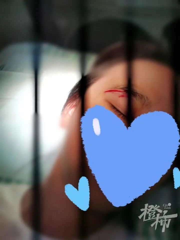 差点伤到眼球!11岁女孩玩密室被绊倒,眼皮缝8针或留疤 差点伤到眼球!11岁女孩玩密室被绊倒,眼皮缝8针或留疤