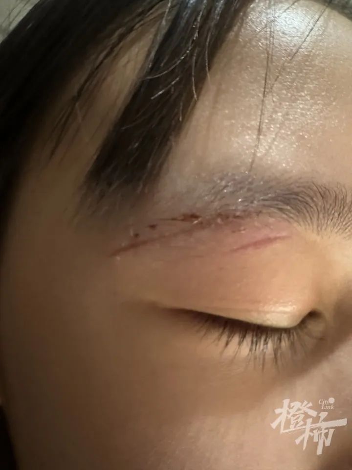 差点伤到眼球!11岁女孩玩密室被绊倒,眼皮缝8针或留疤 差点伤到眼球!11岁女孩玩密室被绊倒,眼皮缝8针或留疤