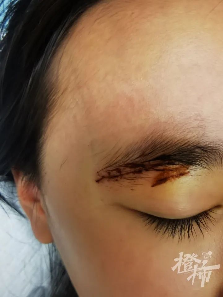 差点伤到眼球!11岁女孩玩密室被绊倒,眼皮缝8针或留疤 差点伤到眼球!11岁女孩玩密室被绊倒,眼皮缝8针或留疤