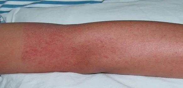 发病比断骨还痛？初期症状和流感相似，上海多区发布提醒→