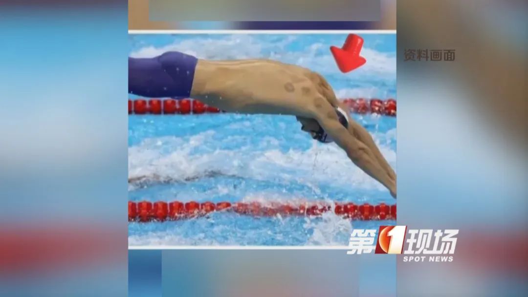 拔火罐在奥运会走红？医生发出提醒：三伏天“祛湿”要适度！