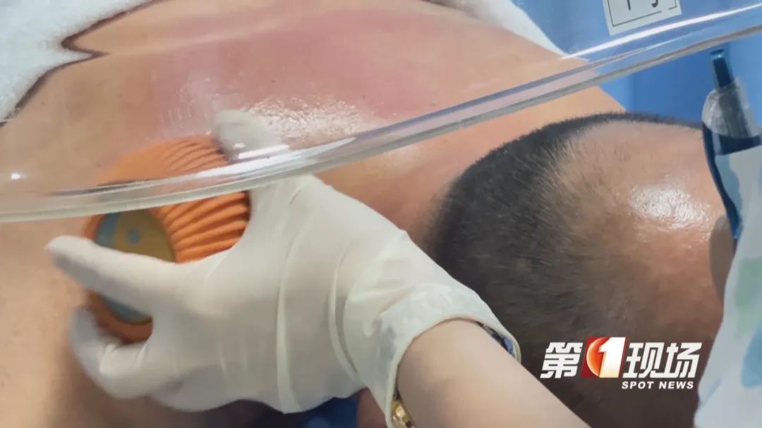 拔火罐在奥运会走红？医生发出提醒：三伏天“祛湿”要适度！