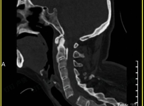 有人颈椎骨折致全身瘫痪！这项夏日活动很多人爱玩