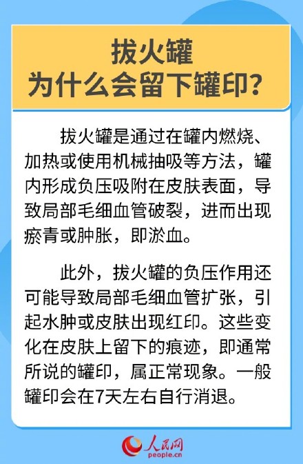 收藏！6问6答了解拔罐疗法