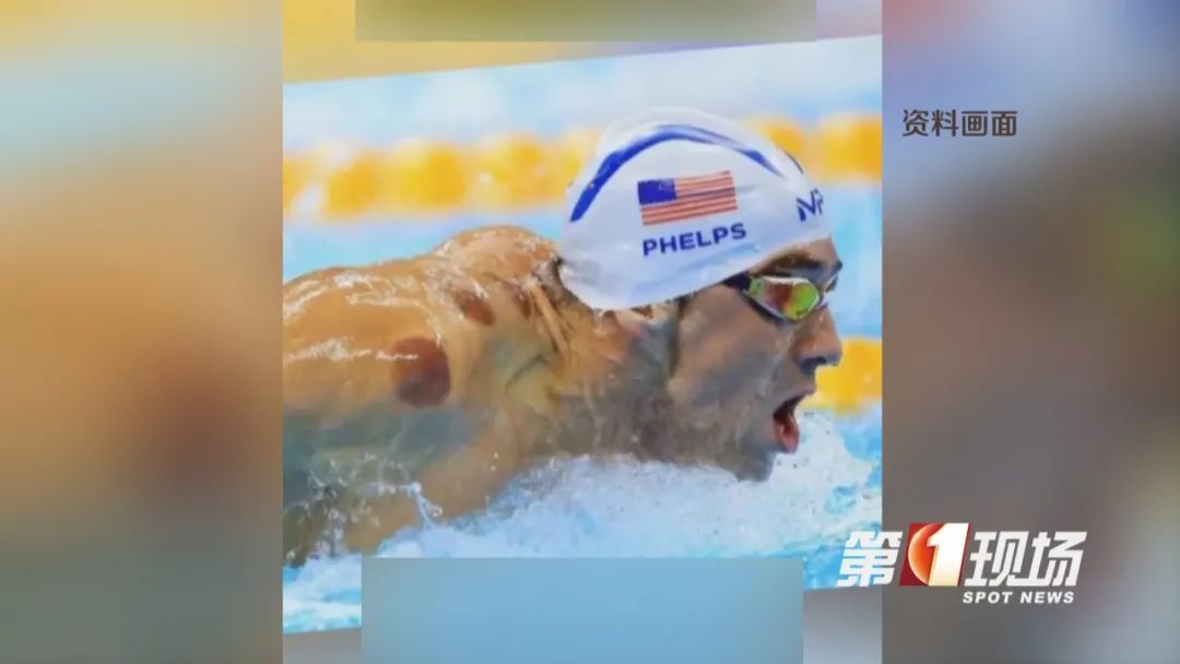 拔火罐在奥运会走红？医生发出提醒：三伏天“祛湿”要适度！