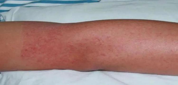 No vaccine, no specific medicine! How to prevent dengue fever? Learn together! No vaccine, no specific medicine! How to prevent dengue fever? Learn together!