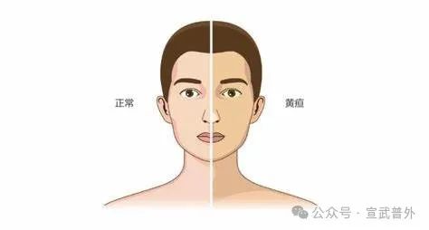 黄疸一定和肝炎“牵手”吗? 黄疸一定和肝炎“牵手”吗?