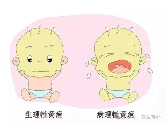 黄疸一定和肝炎“牵手”吗? 黄疸一定和肝炎“牵手”吗?