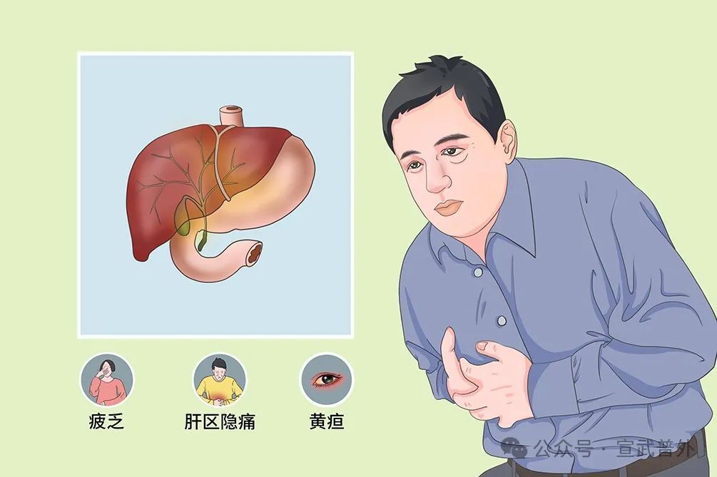 黄疸一定和肝炎“牵手”吗? 黄疸一定和肝炎“牵手”吗?