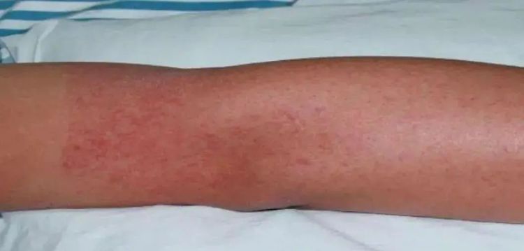 已报告多例确诊病例,无疫苗无特效药!疾控部门紧急提醒 已报告多例确诊病例,无疫苗无特效药!疾控部门紧急提醒