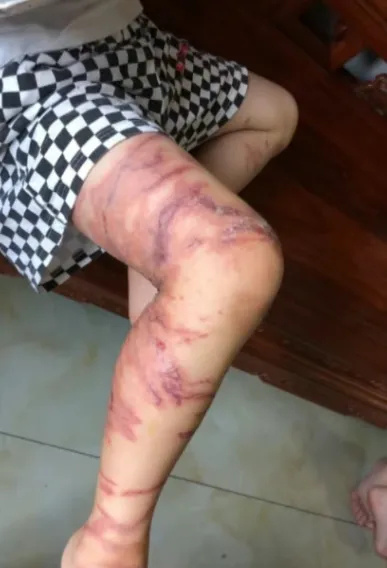 上百人被蜇伤！海边不起眼的“小透明”，杀伤力竟然这么大！紧急提醒