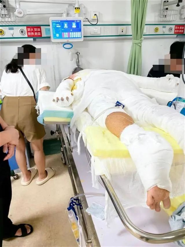 出租屋内，21岁大学生遇煤气罐爆炸起火！全身60%烧伤！