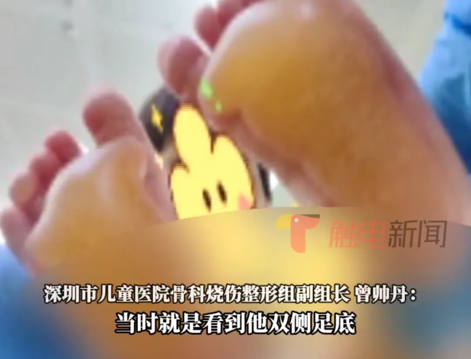 1岁娃光脚跑了5分钟，被烫出超大水泡！这些地方容易烫伤，很多人不知道