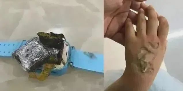 儿童手表突发自燃！10岁男童二级烧伤