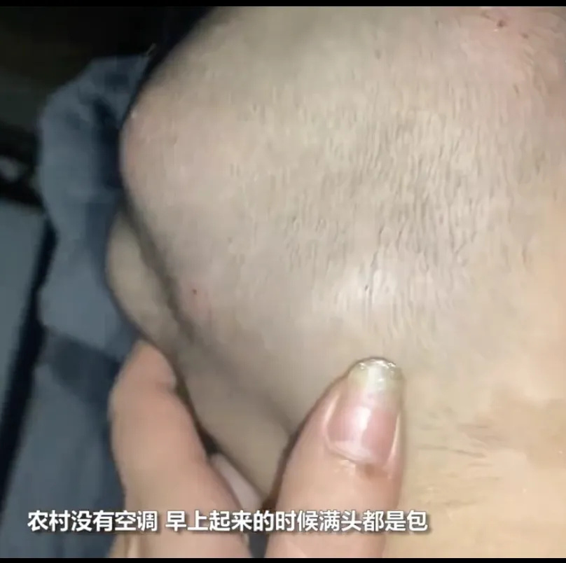 男孩散步回家满头大包如“核桃”？夏季高发！家长们注意