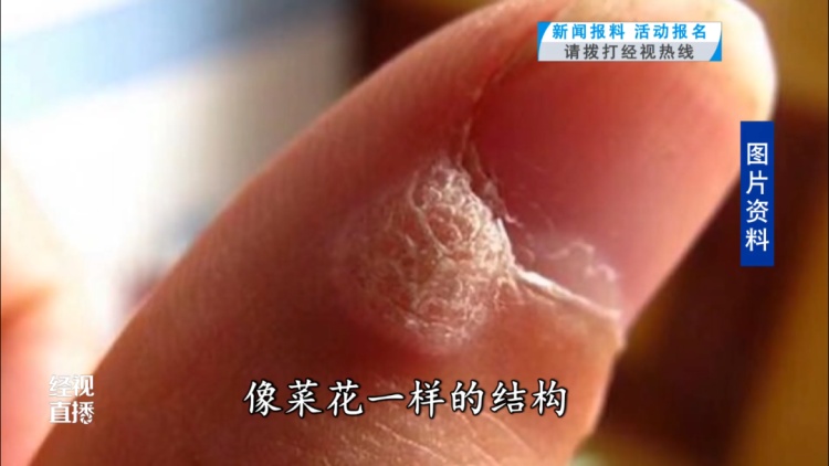 小心，武汉一女子做美甲感染HPV！医生提醒
