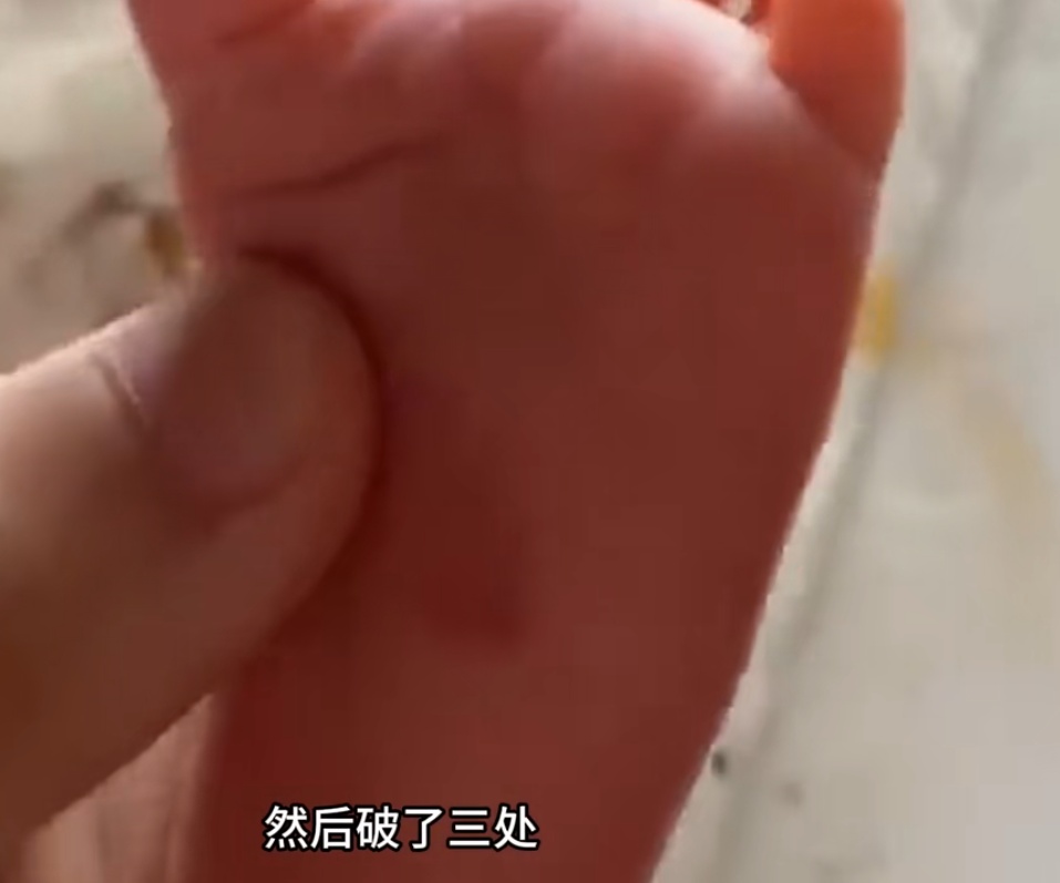 上海一宝妈怒了！月嫂用指甲抠破12天大的婴儿脚底
