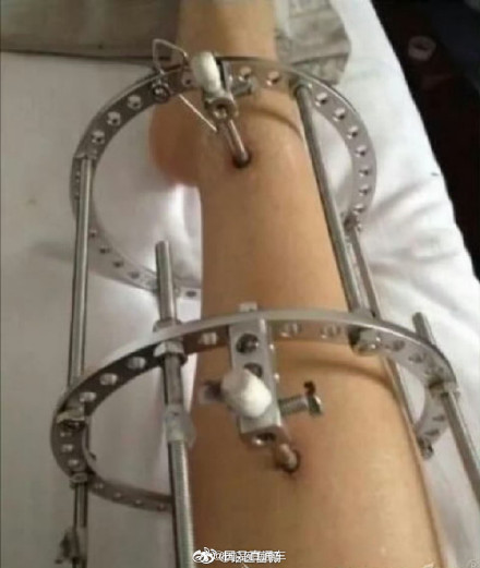 医生称正常人千万别去断骨增高 医生称正常人千万别去断骨增高