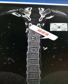 女大学生长着漂亮尖下巴，竟查出罕见病！医生提醒：这些面容可能是罕见病信号