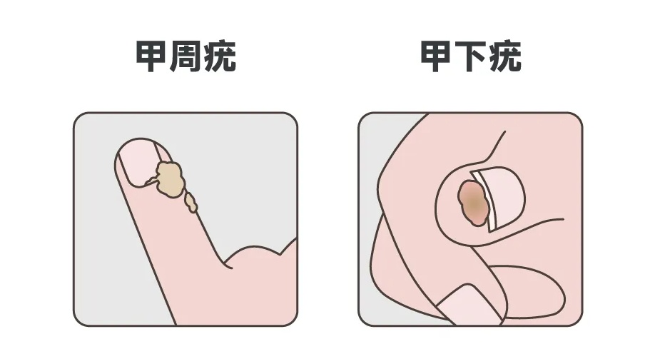 湖北一女子做美甲感染HPV！医生提醒→