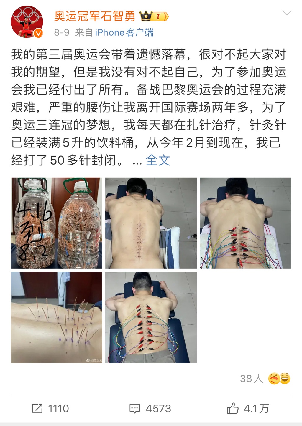 张雨霏肚子上的葫芦灸……这些奥运健儿同款中医疗法重庆也能做！