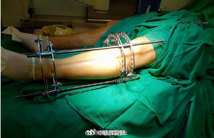 医生称正常人千万别去断骨增高 医生称正常人千万别去断骨增高