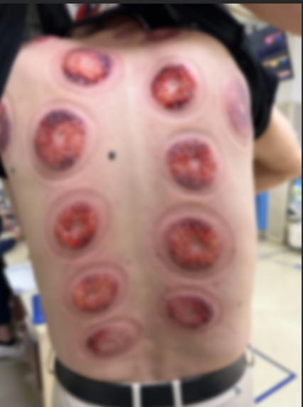 男子背上布满密密麻麻的小水泡！千万别盲目跟风！