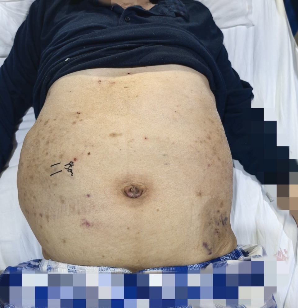 顽固性腹水让男子腹围达107厘米,翻身都难!医生在其体内植入支架 顽固性腹水让男子腹围达107厘米,翻身都难!医生在其体内植入支架