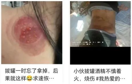 男子背上布满密密麻麻的小水泡！千万别盲目跟风！