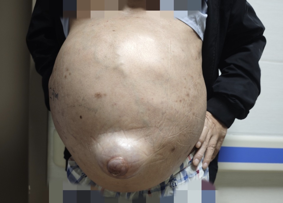 顽固性腹水让男子腹围达107厘米,翻身都难!医生在其体内植入支架 顽固性腹水让男子腹围达107厘米,翻身都难!医生在其体内植入支架