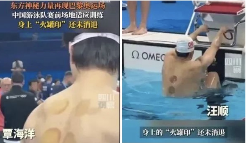 男子背上布满密密麻麻的小水泡！千万别盲目跟风！