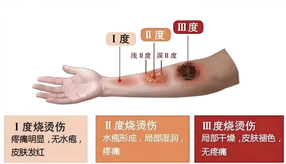 拔火罐致背部Ⅱ度烧伤，自己在家拔火罐可行吗？