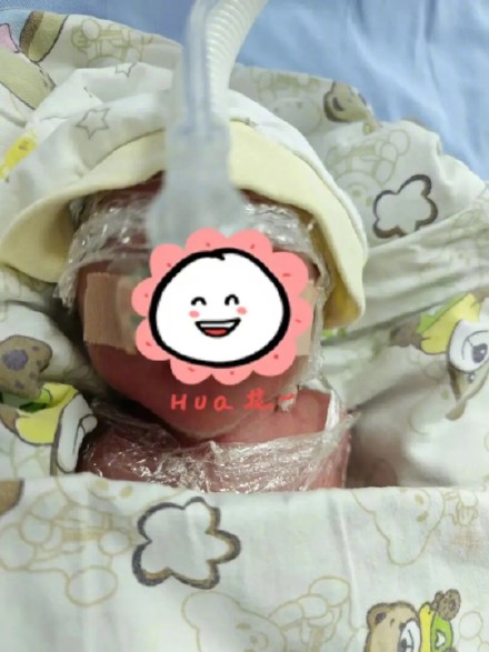 孕妇意外分娩，护士万米高空抢救25周手掌宝宝