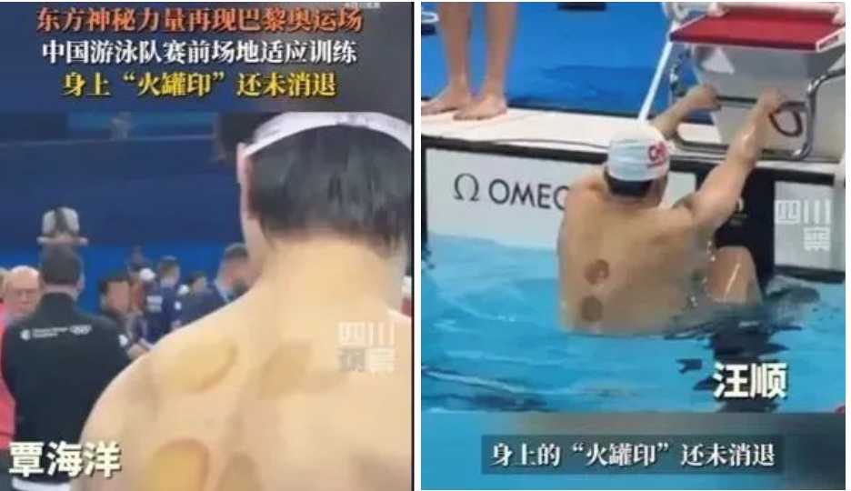 拔火罐致背部Ⅱ度烧伤，自己在家拔火罐可行吗？