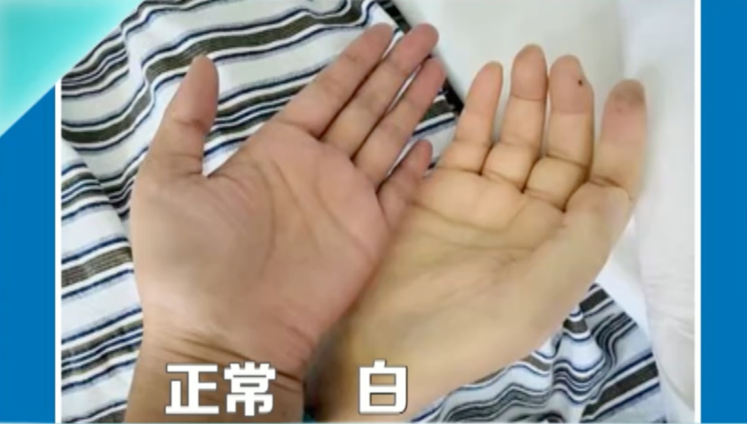 皮肤出现这几个特征，医生建议你去查查血