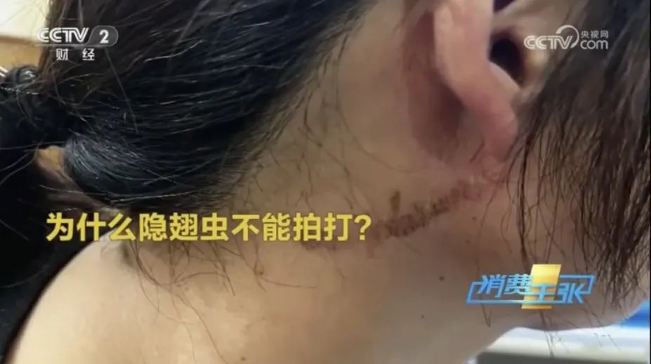 拍死一只虫，竟可能毁容！这个季节应高度警惕！