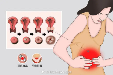 女性出现这些症状要警惕宫颈癌