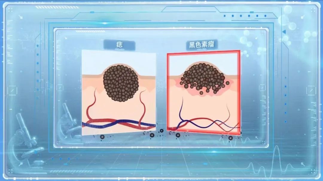 可能癌变！身上有这种痣要注意了，迅速自查