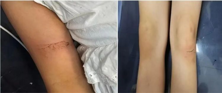 惊险！女童抓娃娃时不慎被机器电击，医生提醒