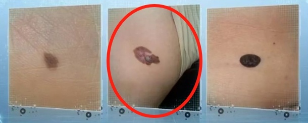 可能癌变！身上有这种痣要注意了，迅速自查