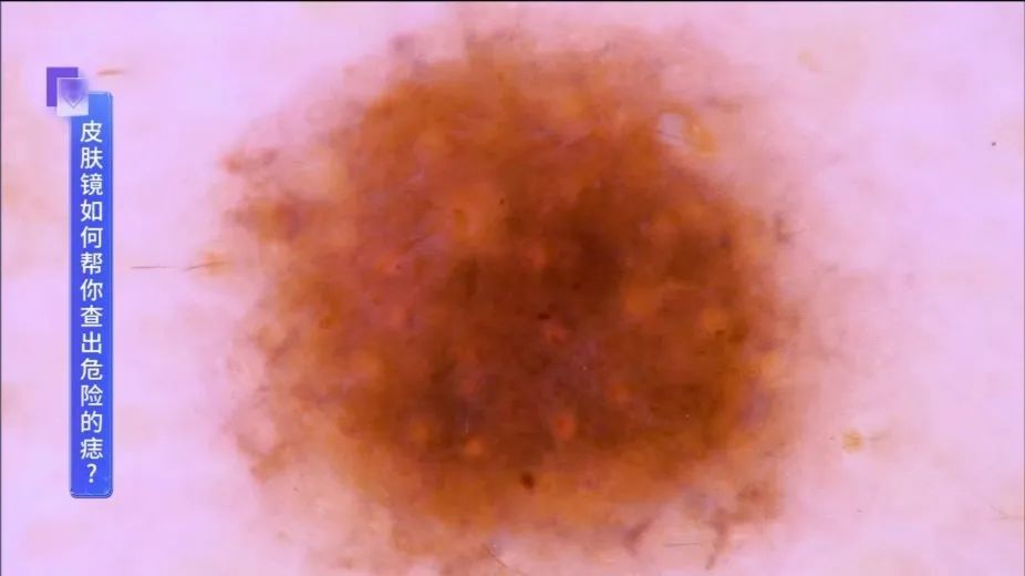 可能癌变！身上有这种痣要注意了，迅速自查