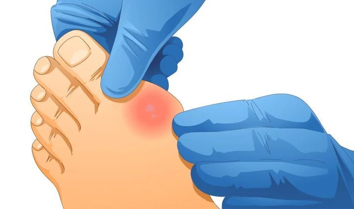 七日食谱，助你度过痛风急性发作期！